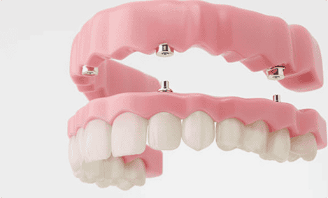 Dental implant denture with pink acrylic base and metal posts for stability.