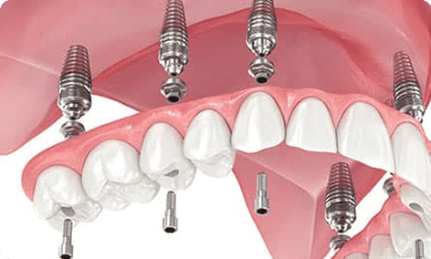 Dental implants with a full arch of teeth and metal screws in the gums.