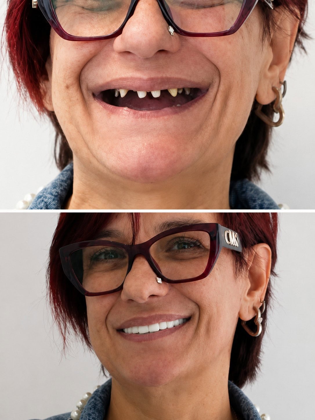Smile transformation showing improved dental health and aesthetics.
