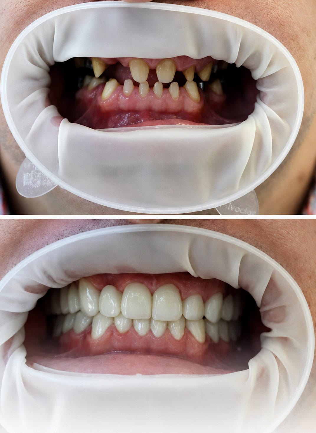 Patient's teeth before and after dental treatment showing significant improvement.