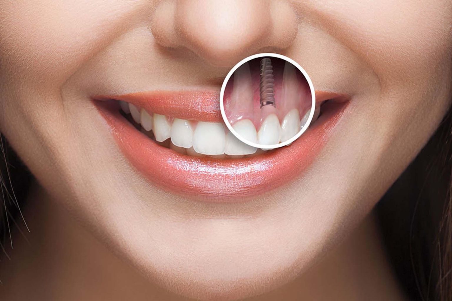 dental implants on mouth