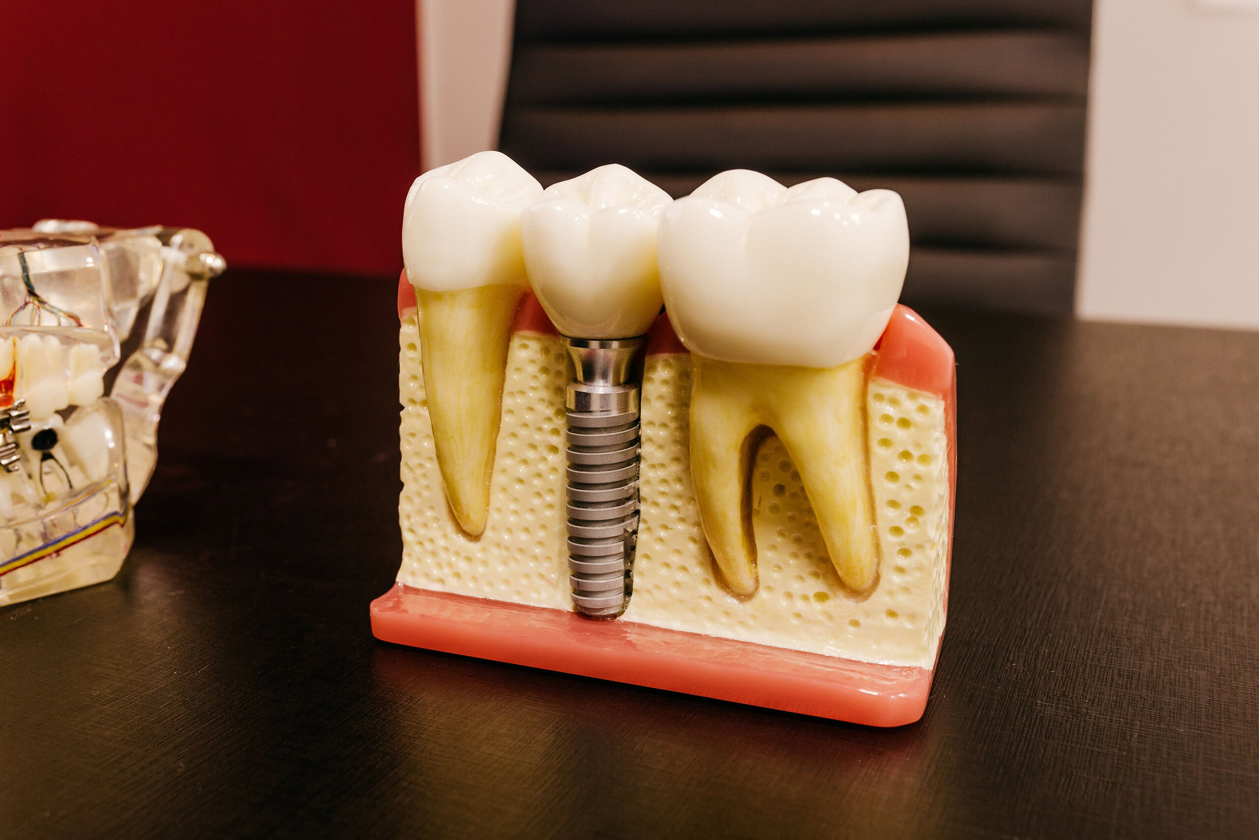 types of dental implants